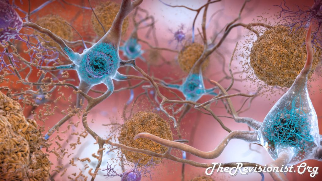 illustration of beta amyloid plaques and tau tangles
